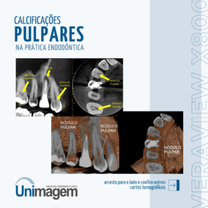 calcificações-pulpares