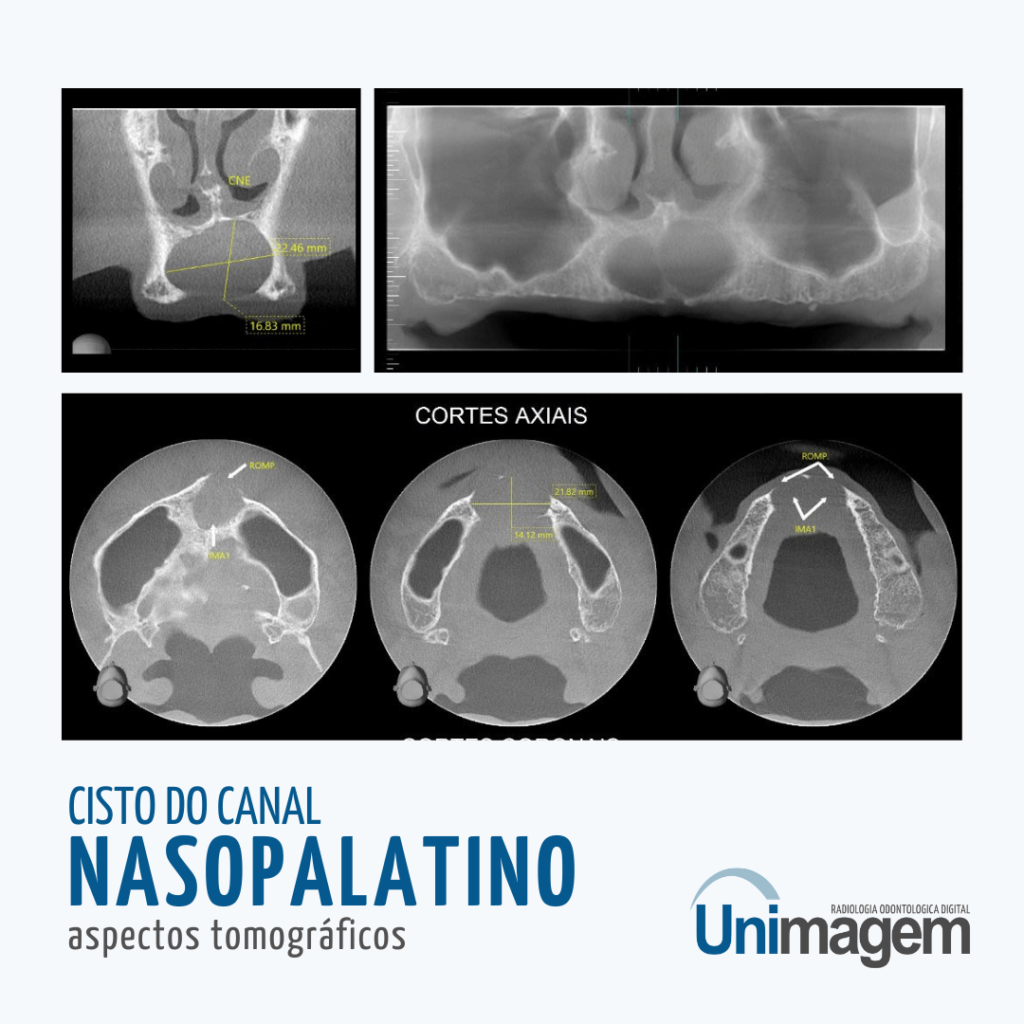 cisto-canal-nasopalatino