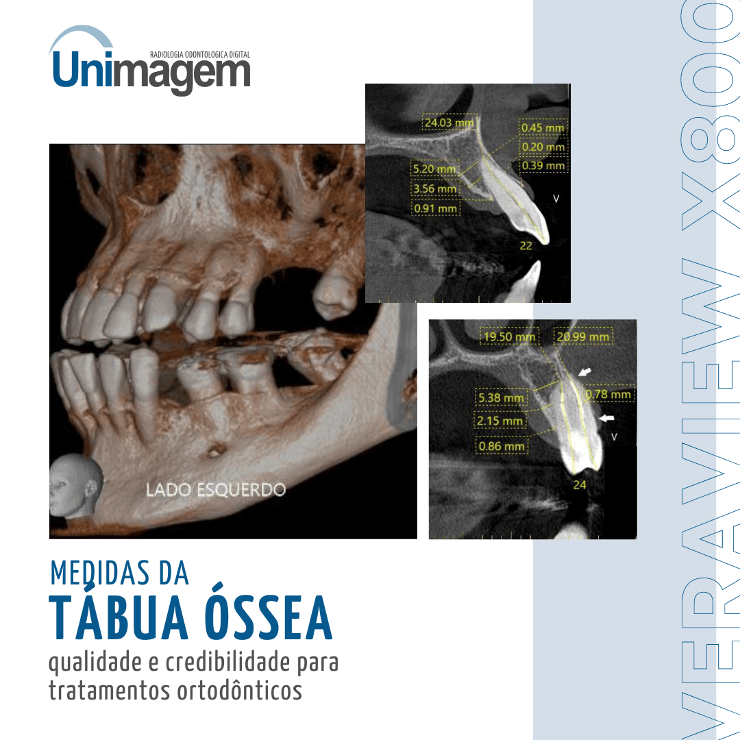 medidas-da-tábua-óssea