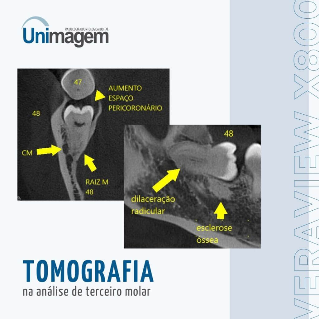 tomografia-terceiro-molar