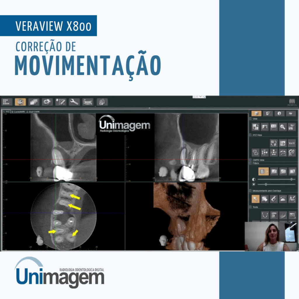 Com o Veraview x800 é possível reduzir os ruídos da imagem.