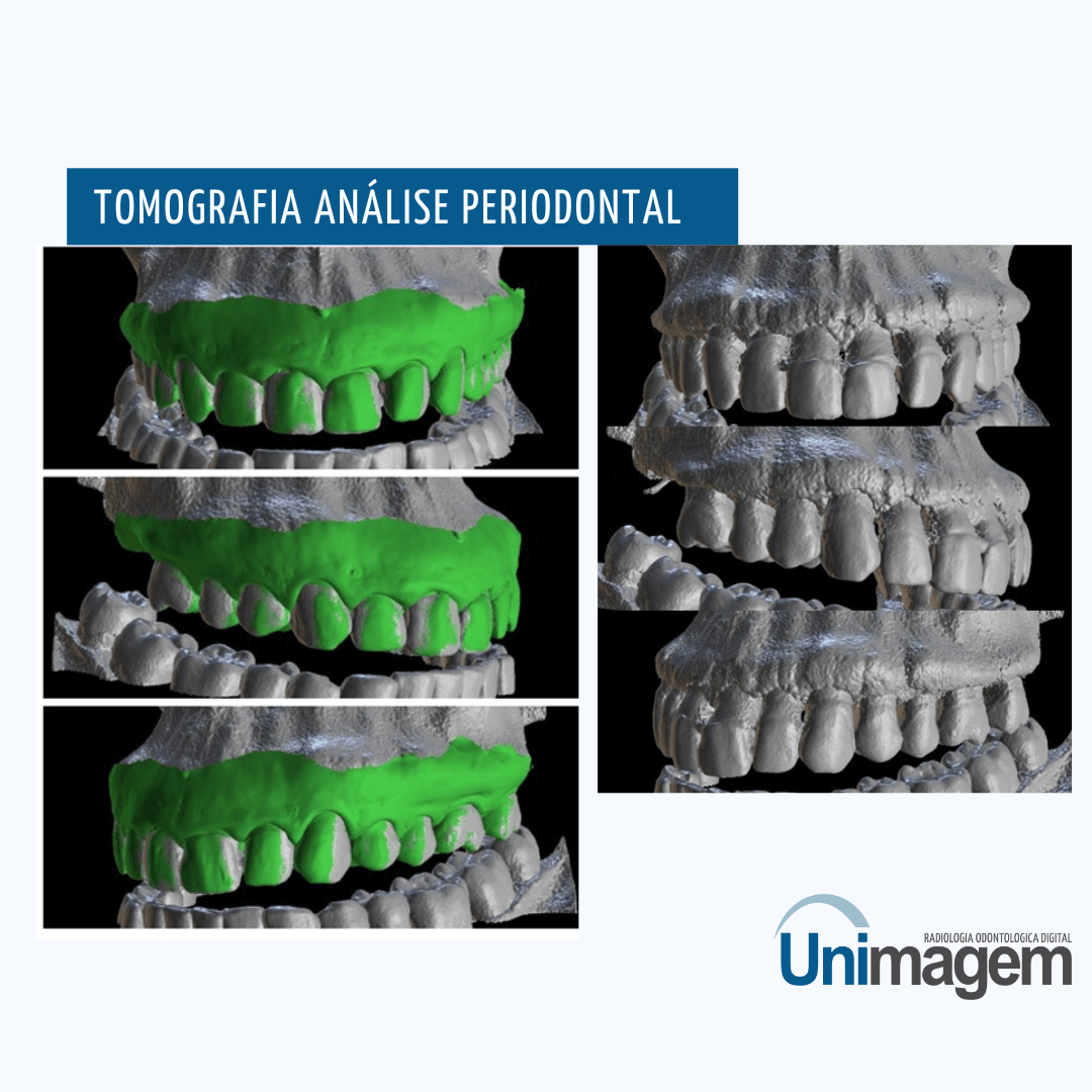 tomografia-análise-periodontal