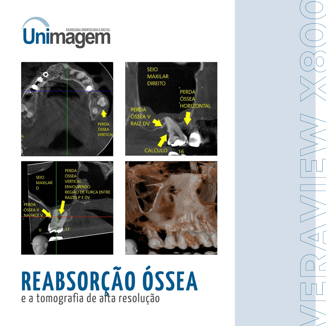 Diferentes cortes de um exame tomógrafico apontando reabsorção óssea