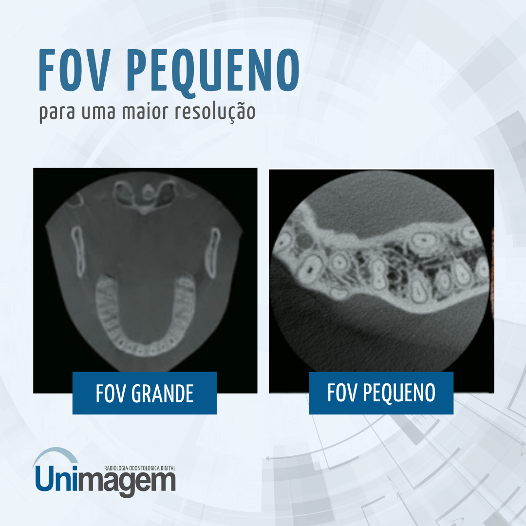 Imagens tomográficas comparando um FOV maior a um FOV pequeno