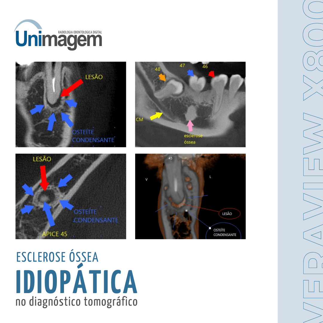 Imagens tomográficas apontando esclerose óssea idiopática