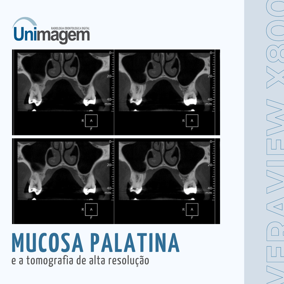 Imagens tomográficas da mucosa palatina