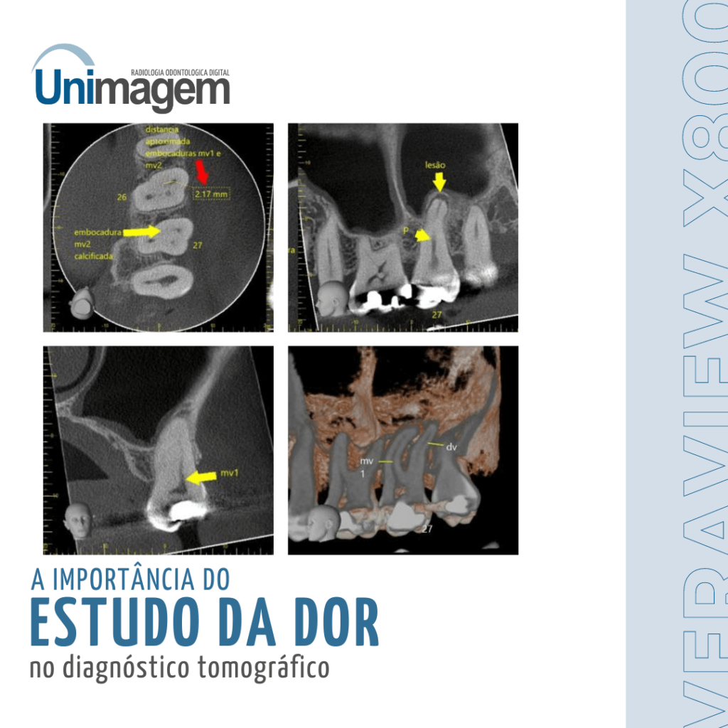 Imagens tomográficas dos dentes 26 e 27 para investigar a origem da dor