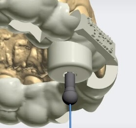 endodontia-guiada