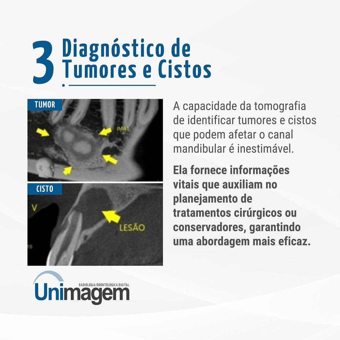 tomografia-no-diagnostico-de-patologias-na-mandibula