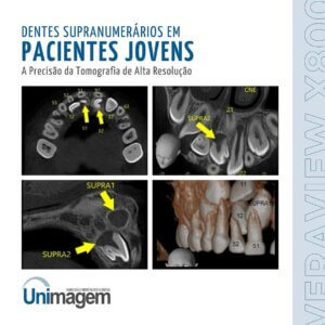 dentes-supranumerarios-em-pacientes-jovens