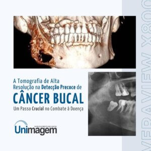 a-tomografia-de-alta-resolucao-na-deteccao-precoce-de-cancer-bucal