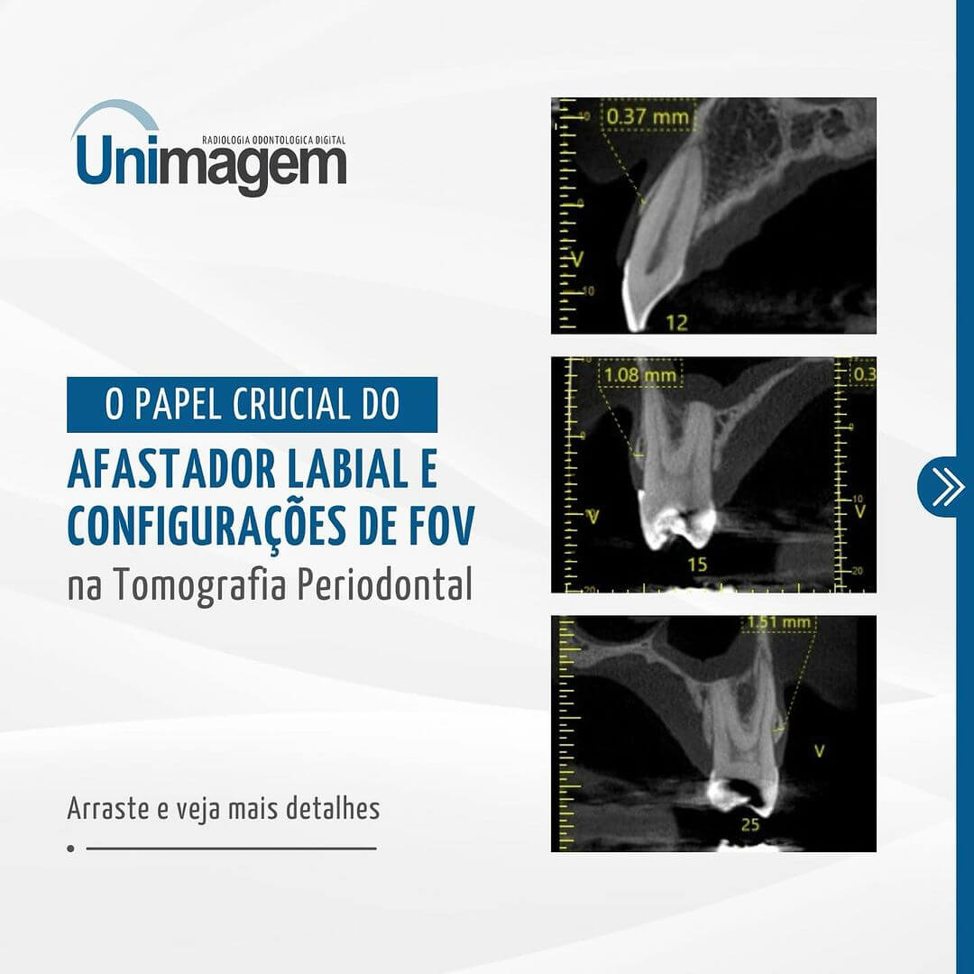 afastador-labial-e-configuracoes-de-fov