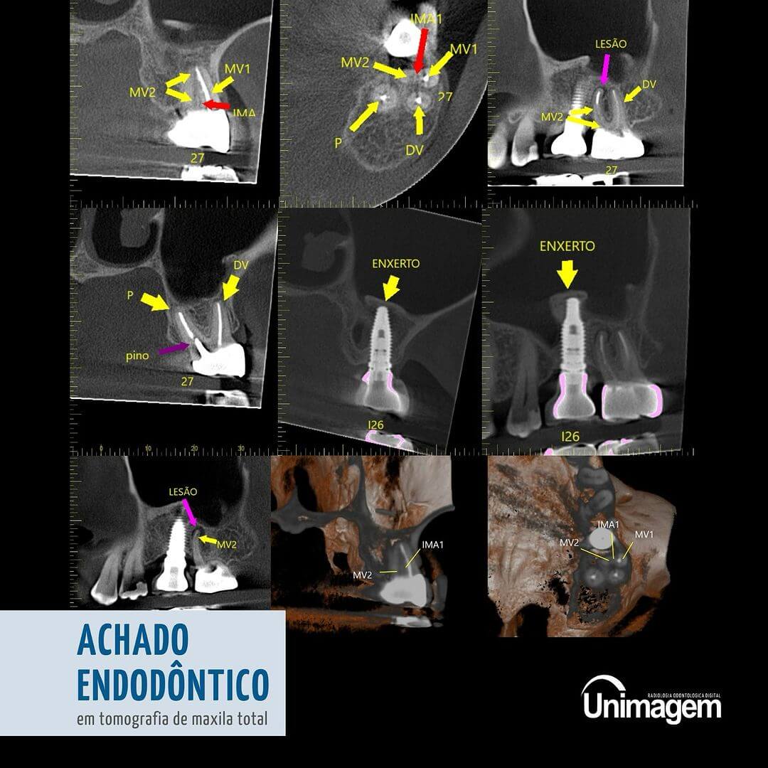 achado-endodontico