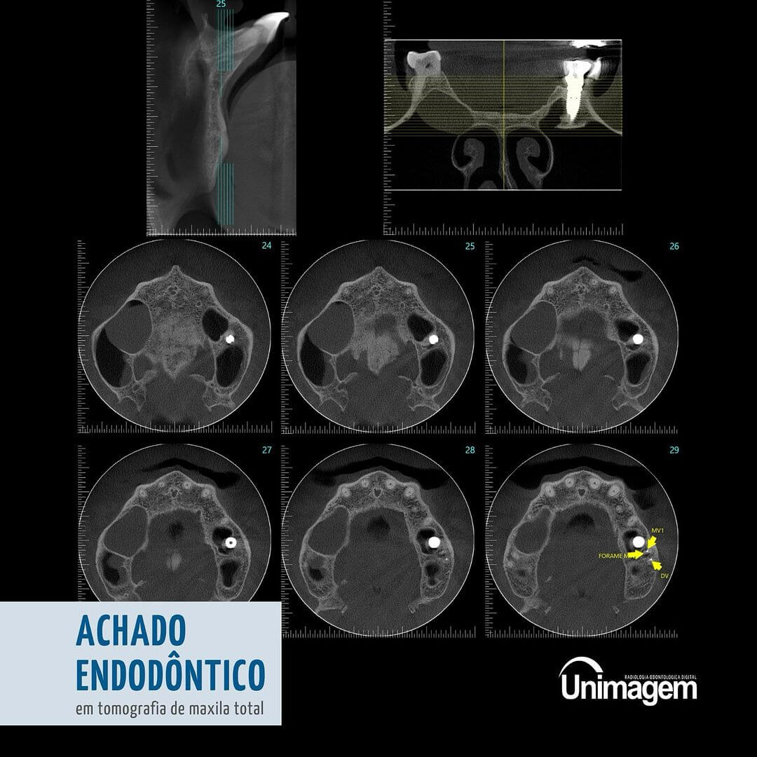 achado-endodontico