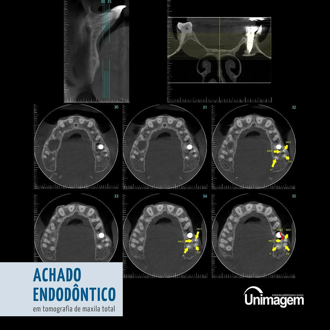 achado-endodontico