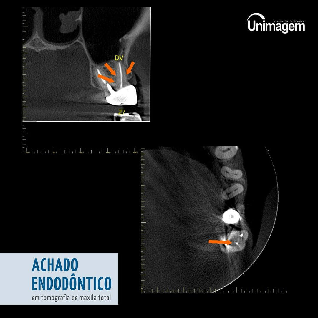 achado-endodontico