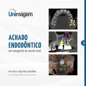 achado-endodontico