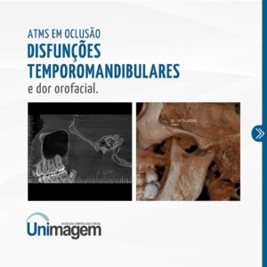 disfuncoes-temporomandibulares