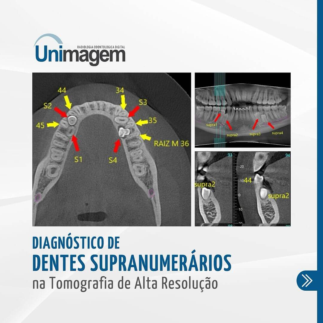 diagnostico-de-dentes-supranumerarios