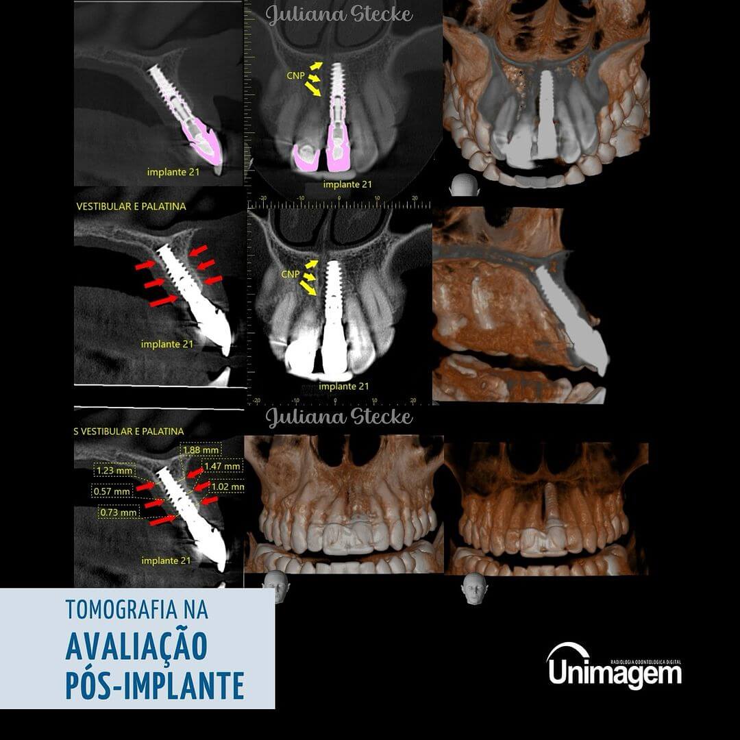 tomografia-na-avaliacao-pos-implante