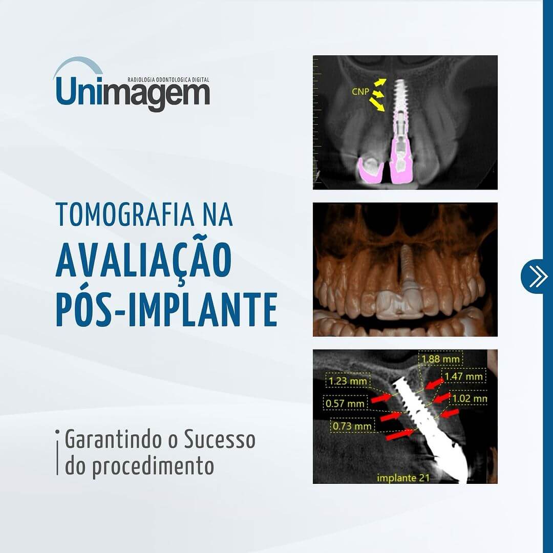 tomografia-na-avaliacao-pos-implante