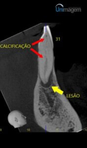 endodontia-guiada