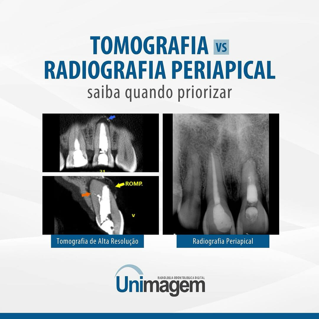 tomografia-vs-radiografia-periapical