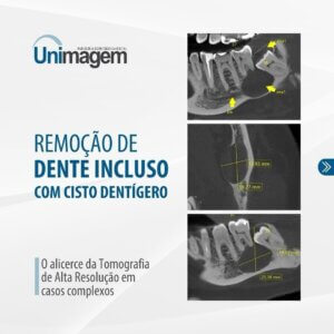 remocao-de-dente-incluso