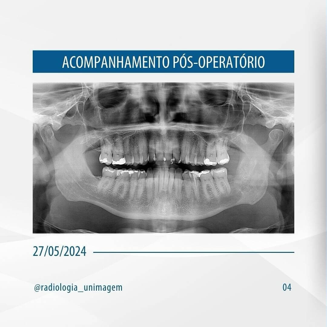 remocao-de-dente-incluso