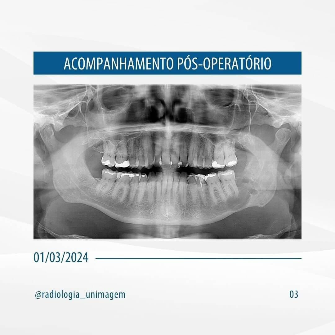 remocao-de-dente-incluso