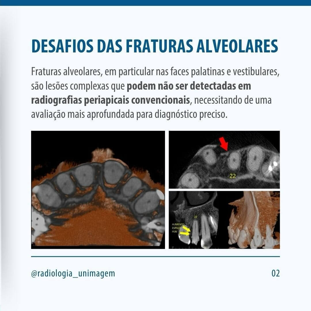 fraturas-alveolares-ocultas