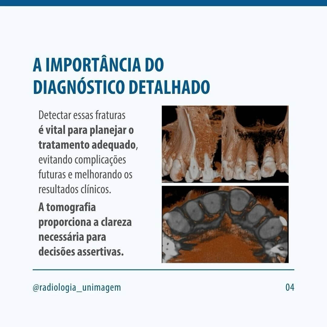 fraturas-alveolares-ocultas
