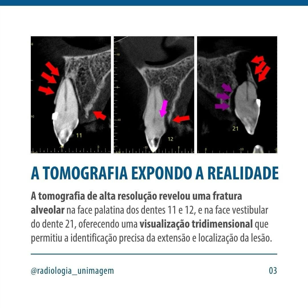 fraturas-alveolares-ocultas