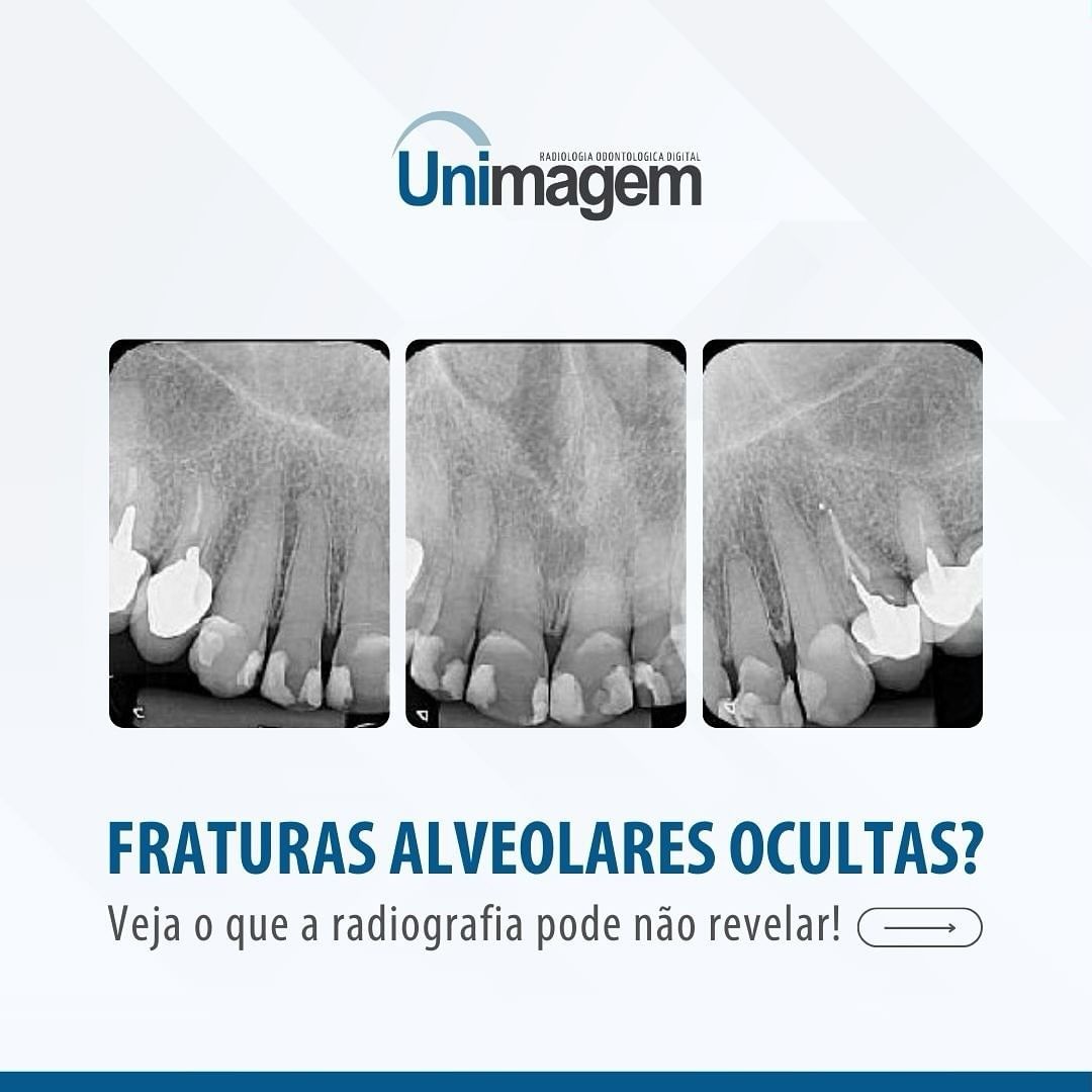 fraturas-alveolares-ocultas