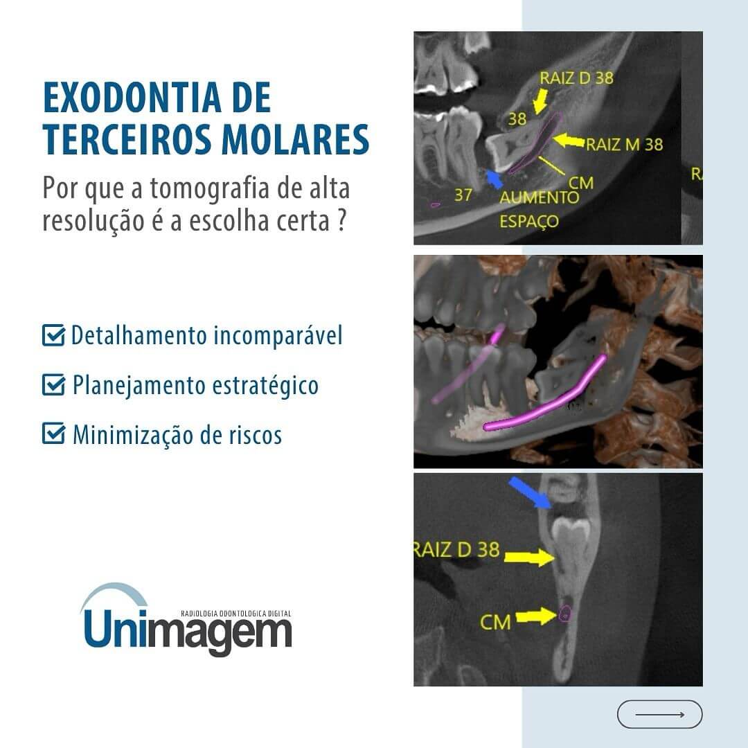 exodontia-de-terceiros-molares
