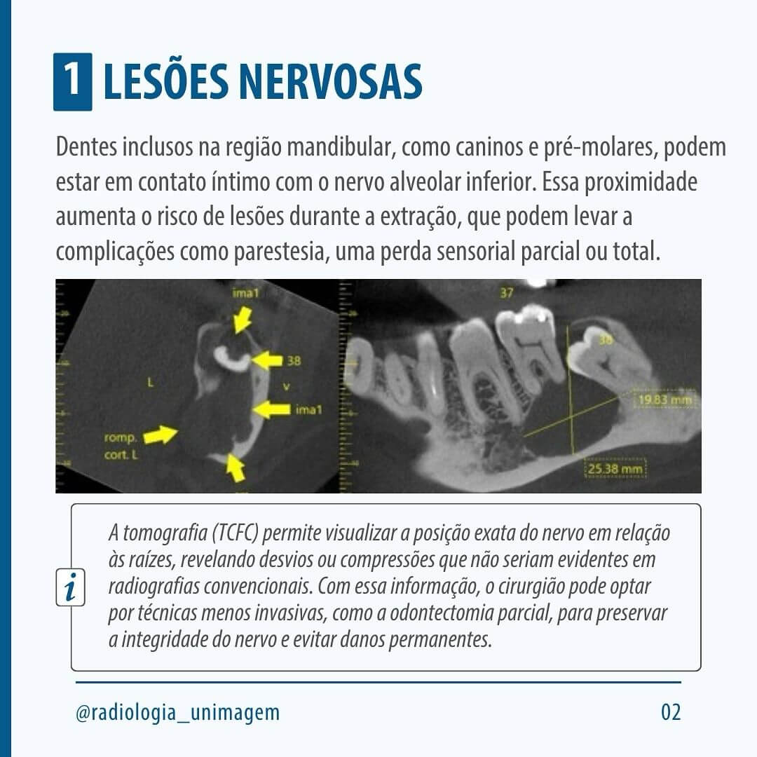 exodontia-de-dentes-inclusos