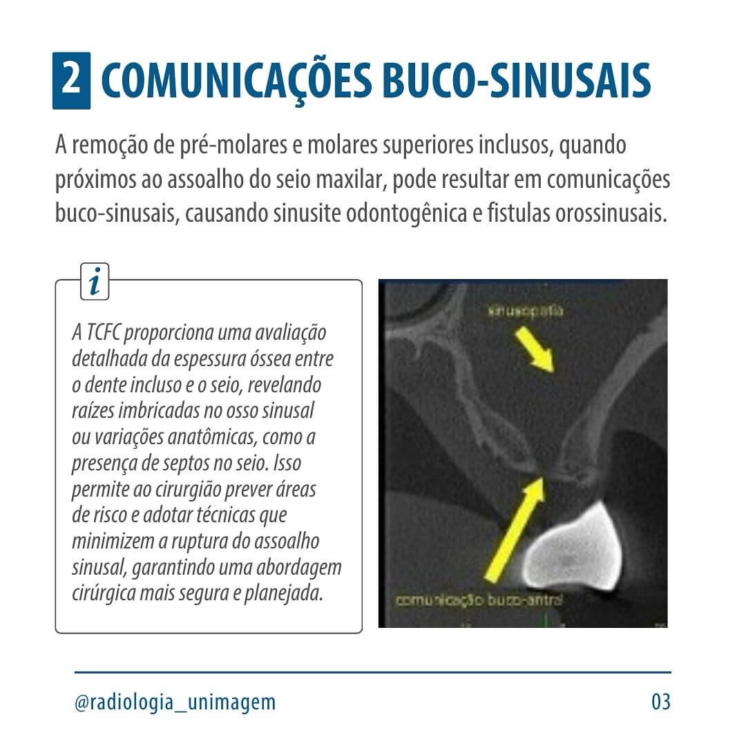 exodontia-de-dentes-inclusos