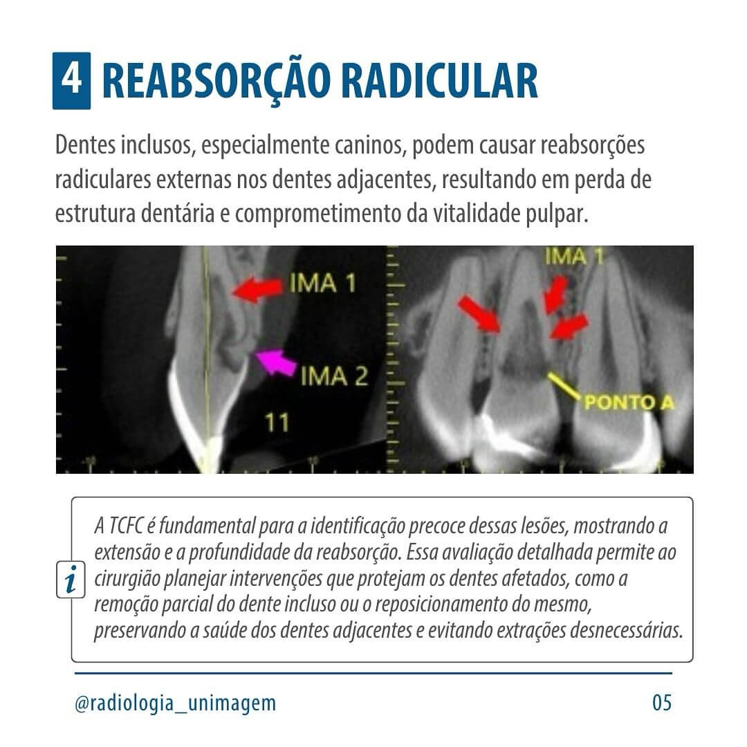 exodontia-de-dentes-inclusos