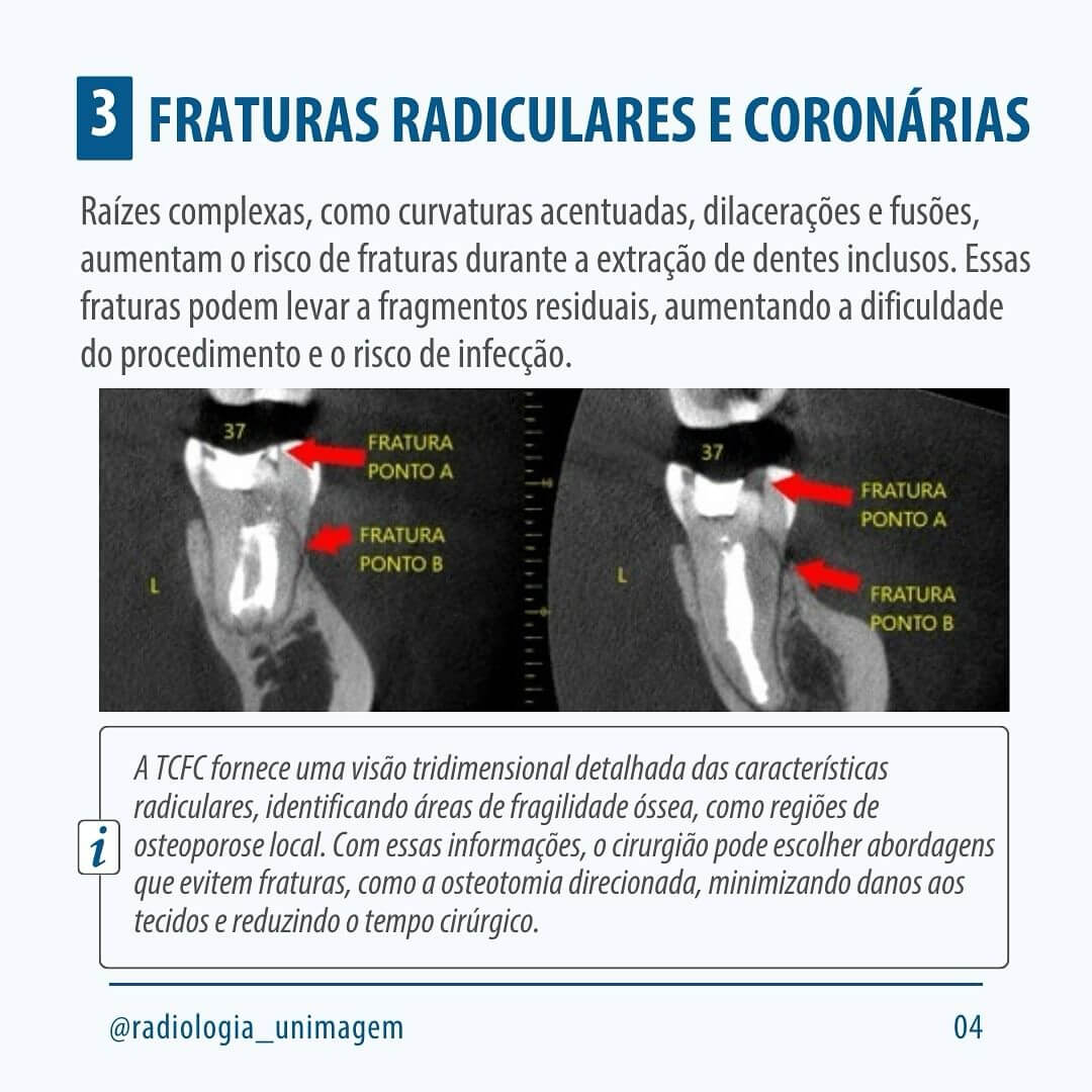 exodontia-de-dentes-inclusos