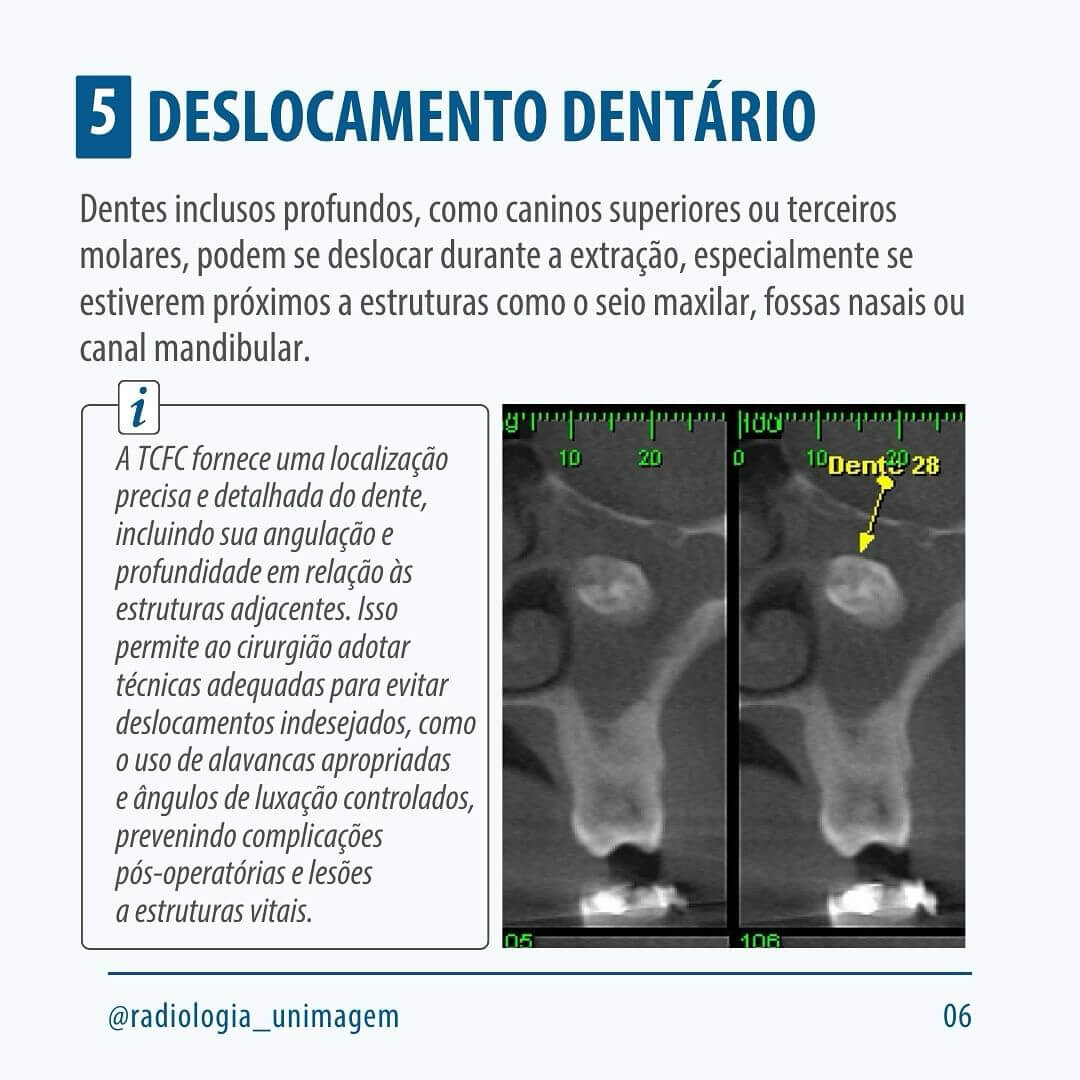 exodontia-de-dentes-inclusos