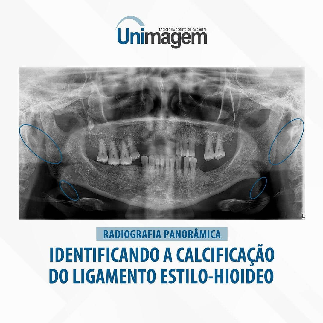 calcificacao-do-ligamento-estilo-hioideo