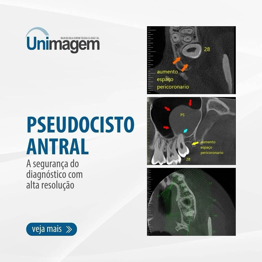 pseudocisto-antral