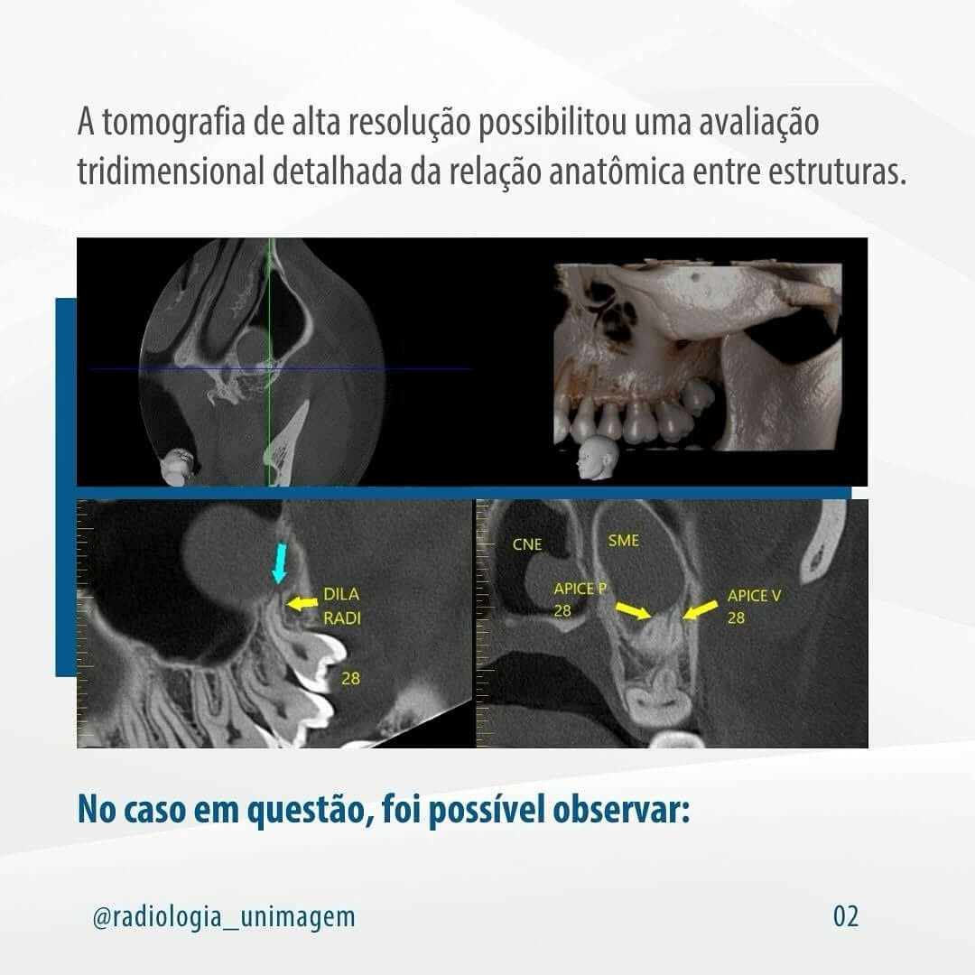 pseudocisto-antral
