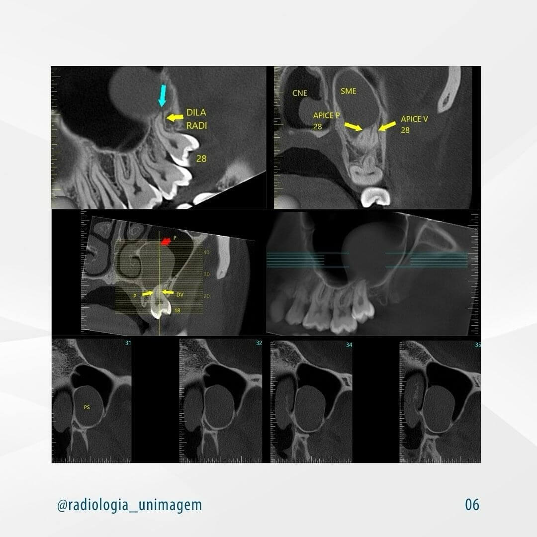 pseudocisto-antral