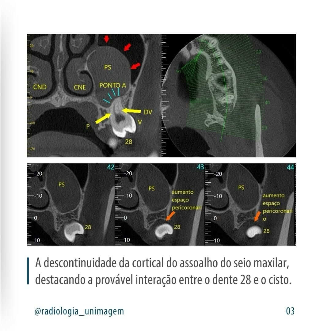 pseudocisto-antral