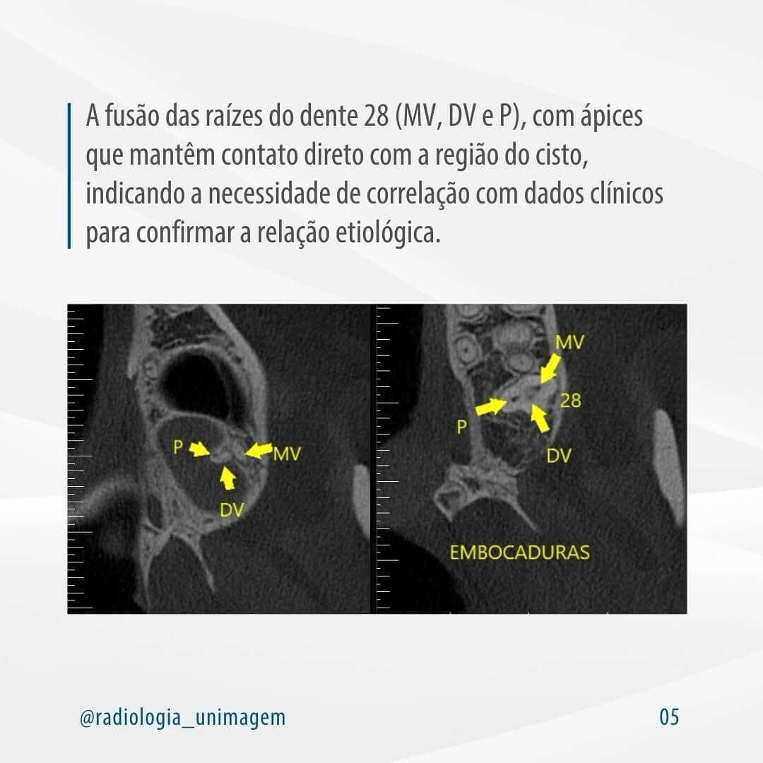 pseudocisto-antral